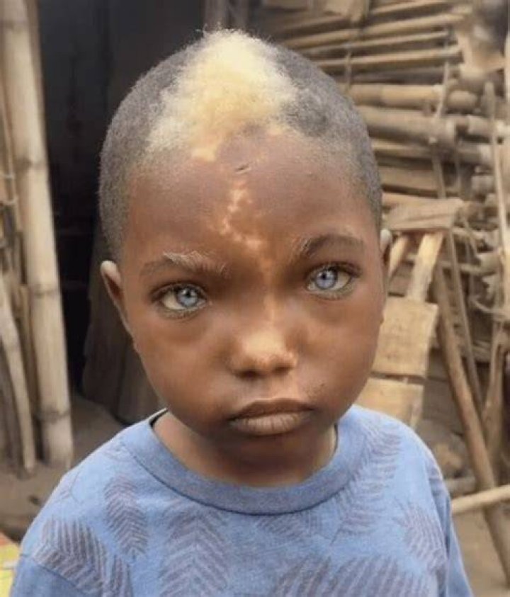 Can humans be born with green hair?