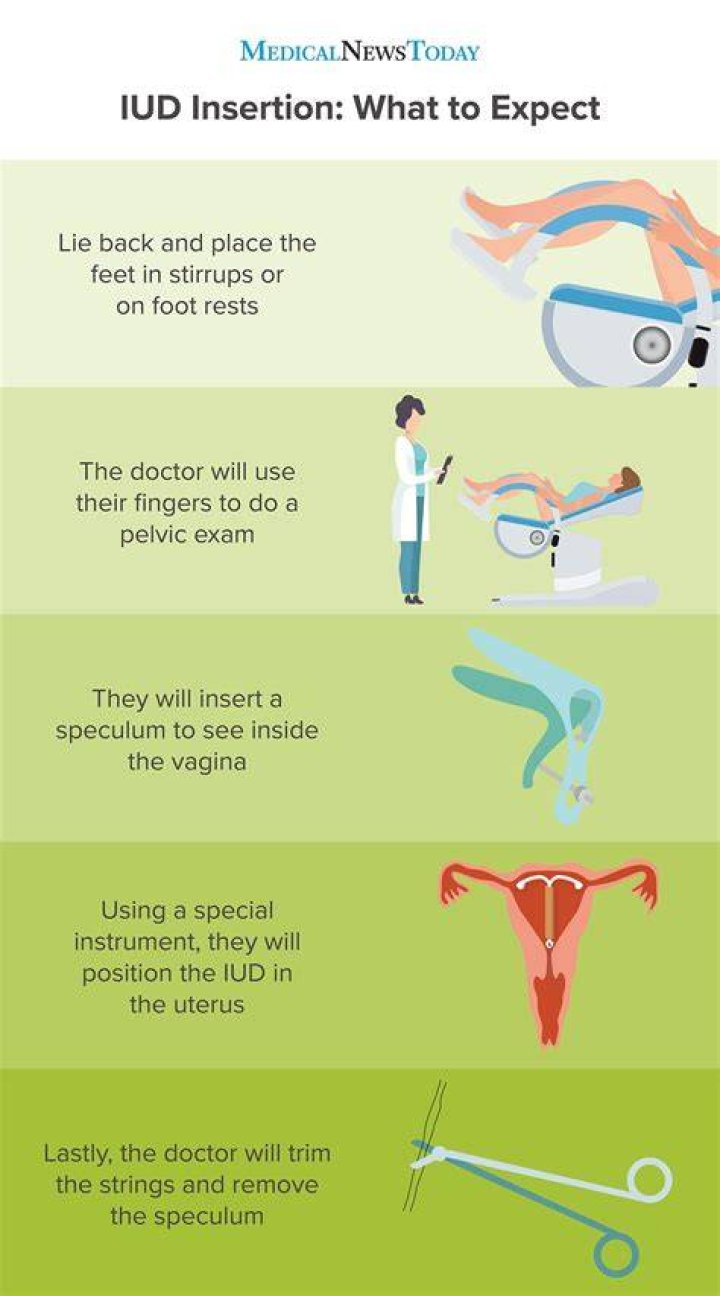 Can you lose weight after IUD removal?