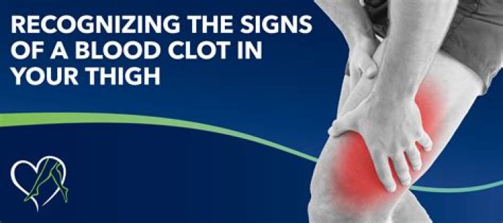 How can I tell if I have a blood clot in my leg?