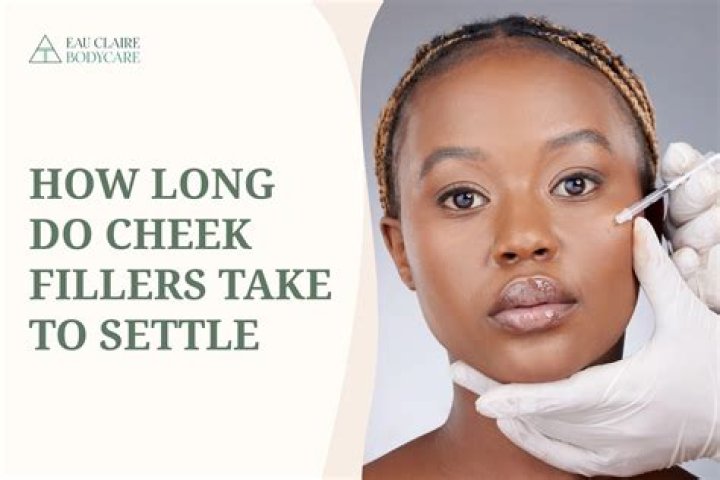 How long do fillers take to settle?