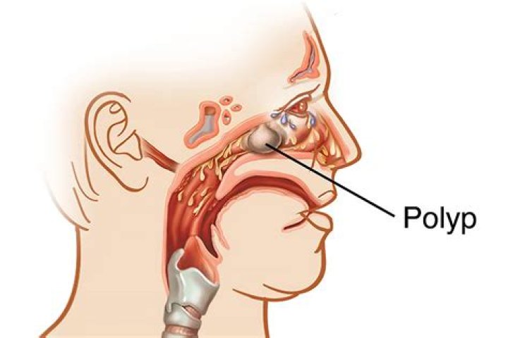How long do you bleed after having a polyp removed?
