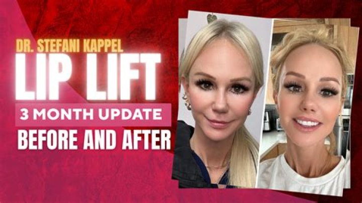 Is a lip lift worth it?