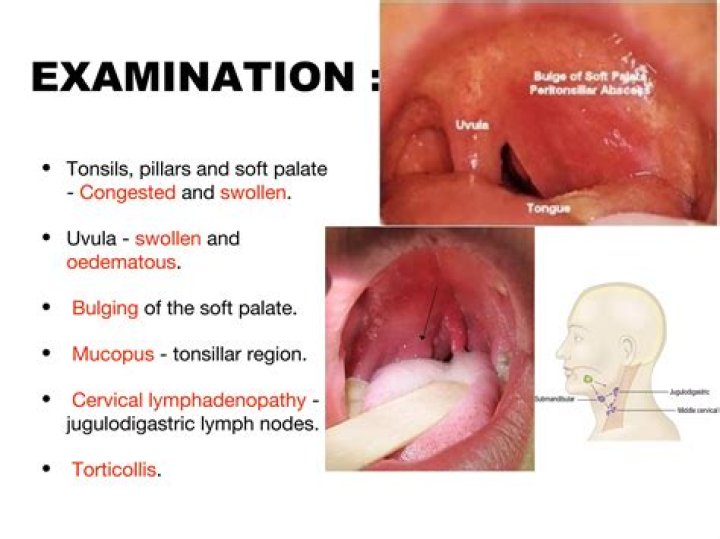 What is a Quincy throat?