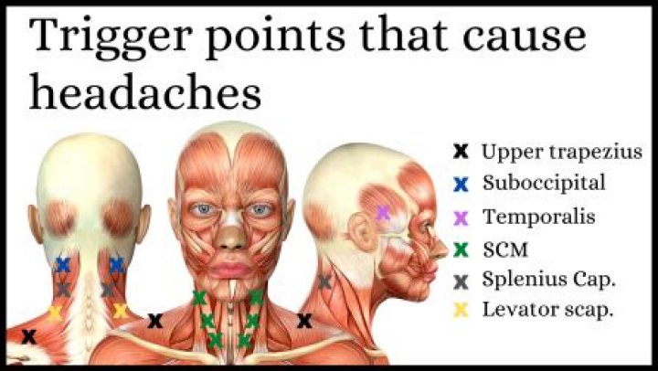 What trigger points cause headaches?