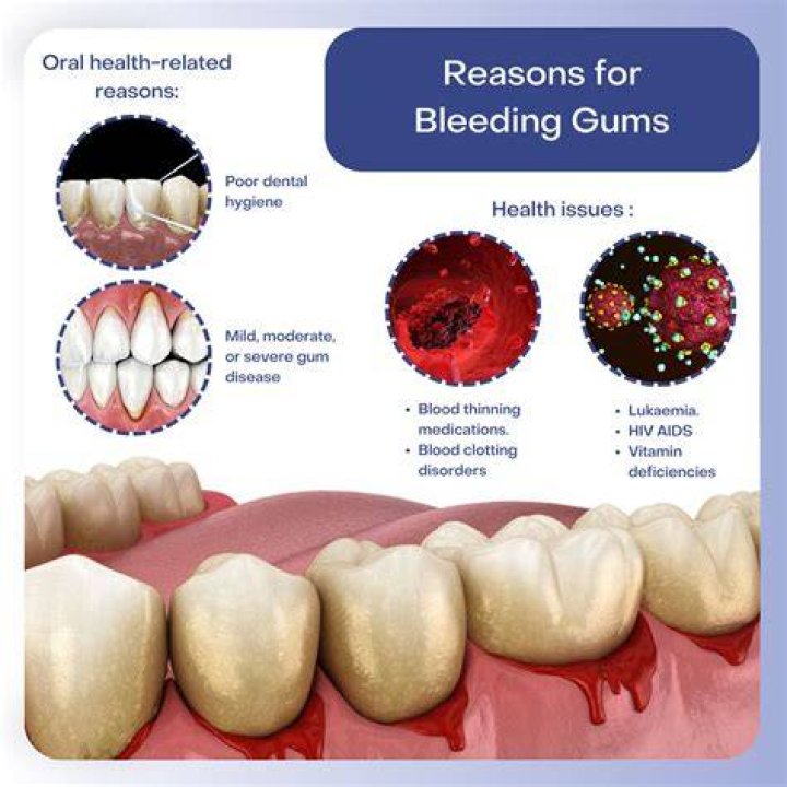 Why do my gums bleed when I get my teeth cleaned?
