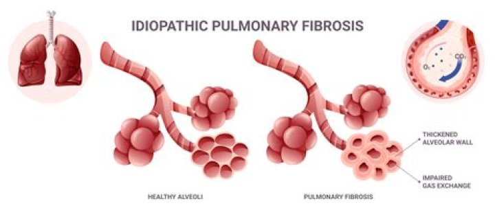 Will a lung transplant cure IPF?